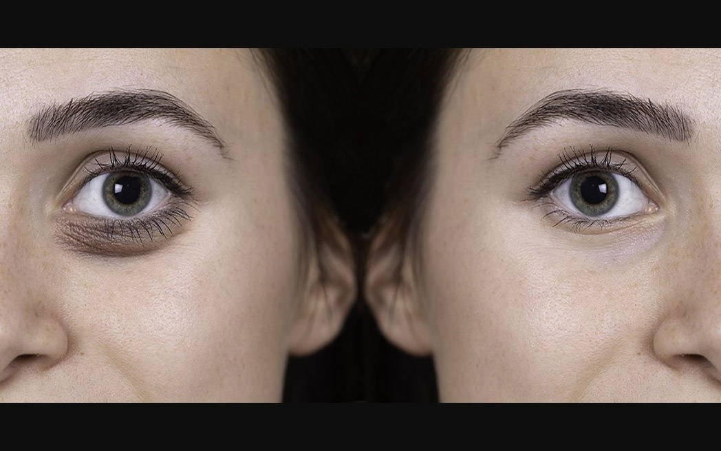 botox-brow-lift_1048